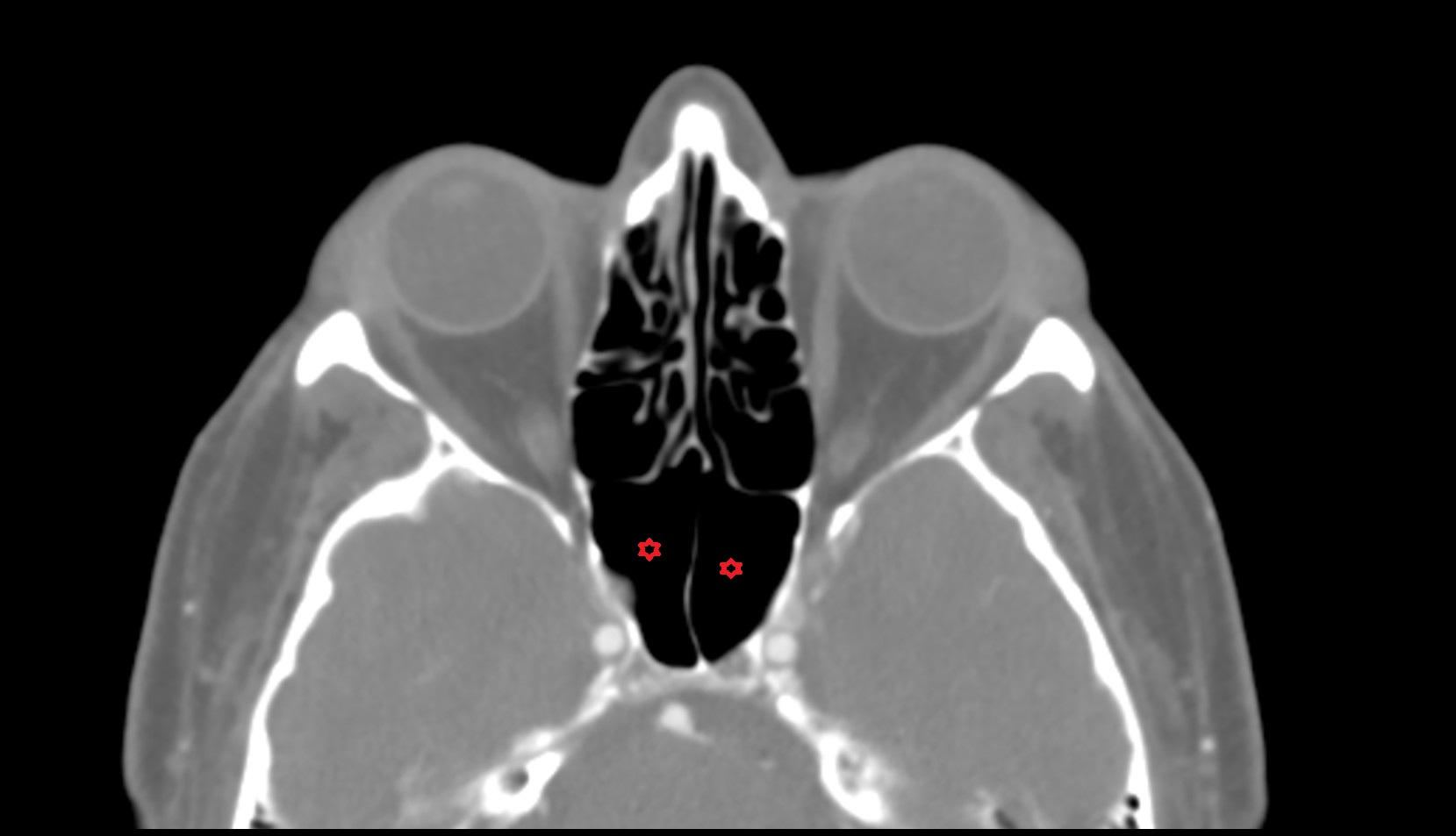 Sphenoid sinus CT