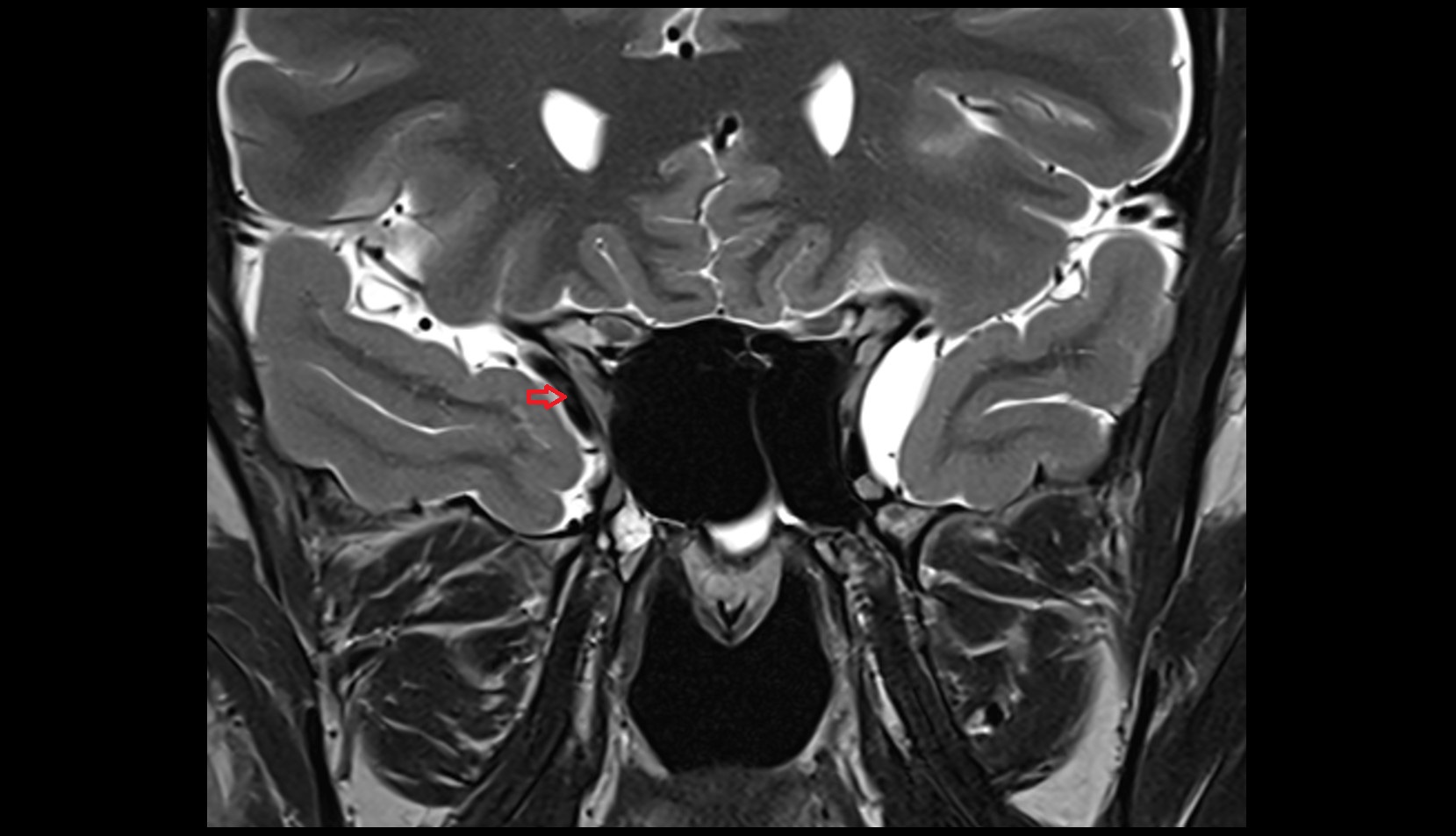 Sphenoparietal sinus