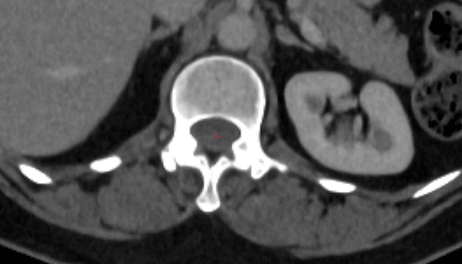Spinal cord  CT axial anatomy  image-img-00000-00000