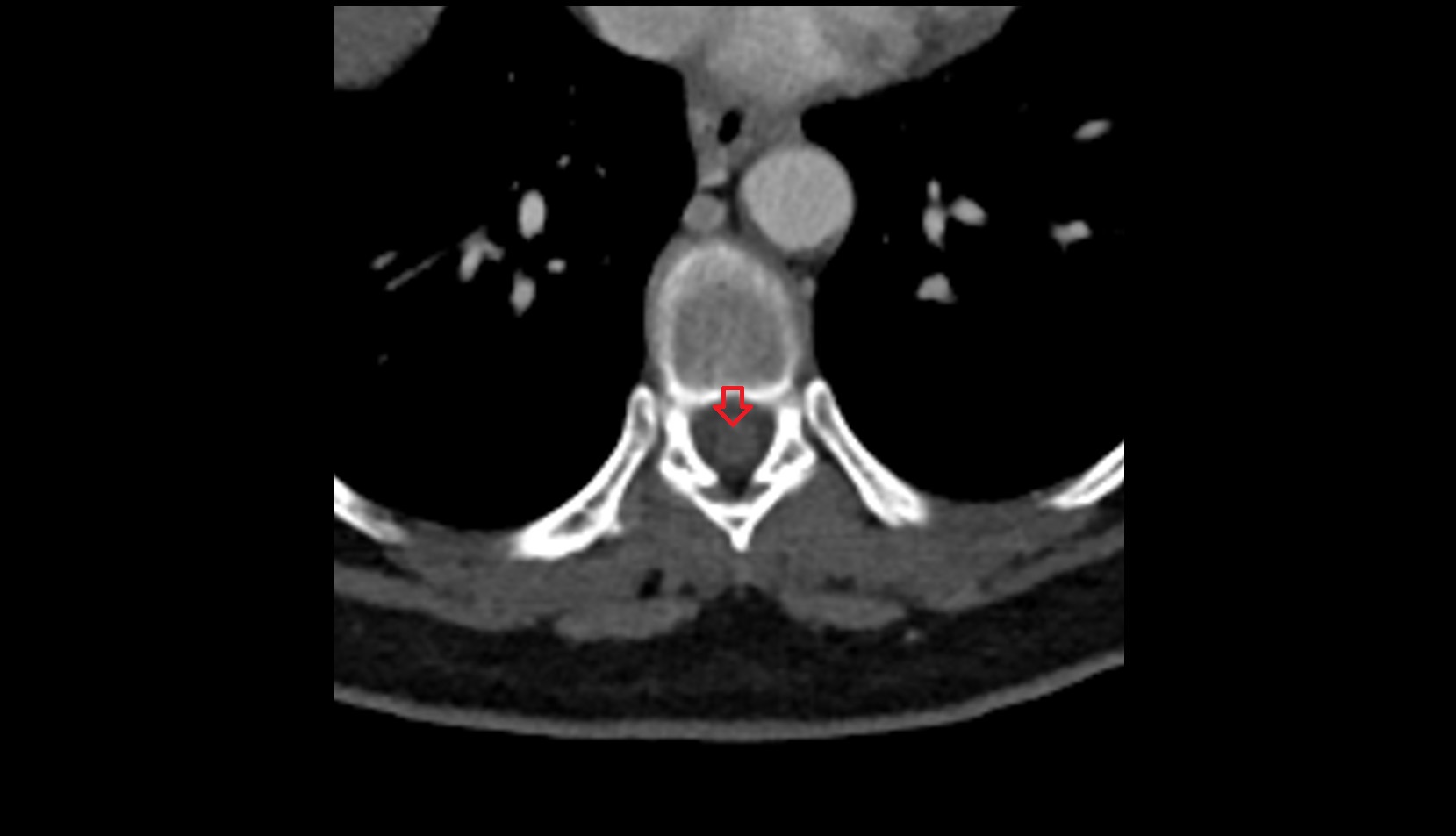 Spinal cord ct axial image