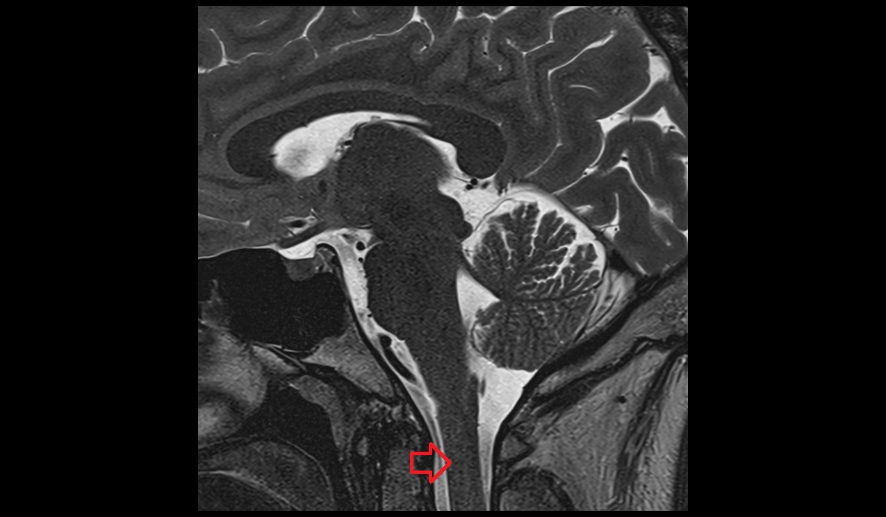 Spinal cord mri 3t sagittal image