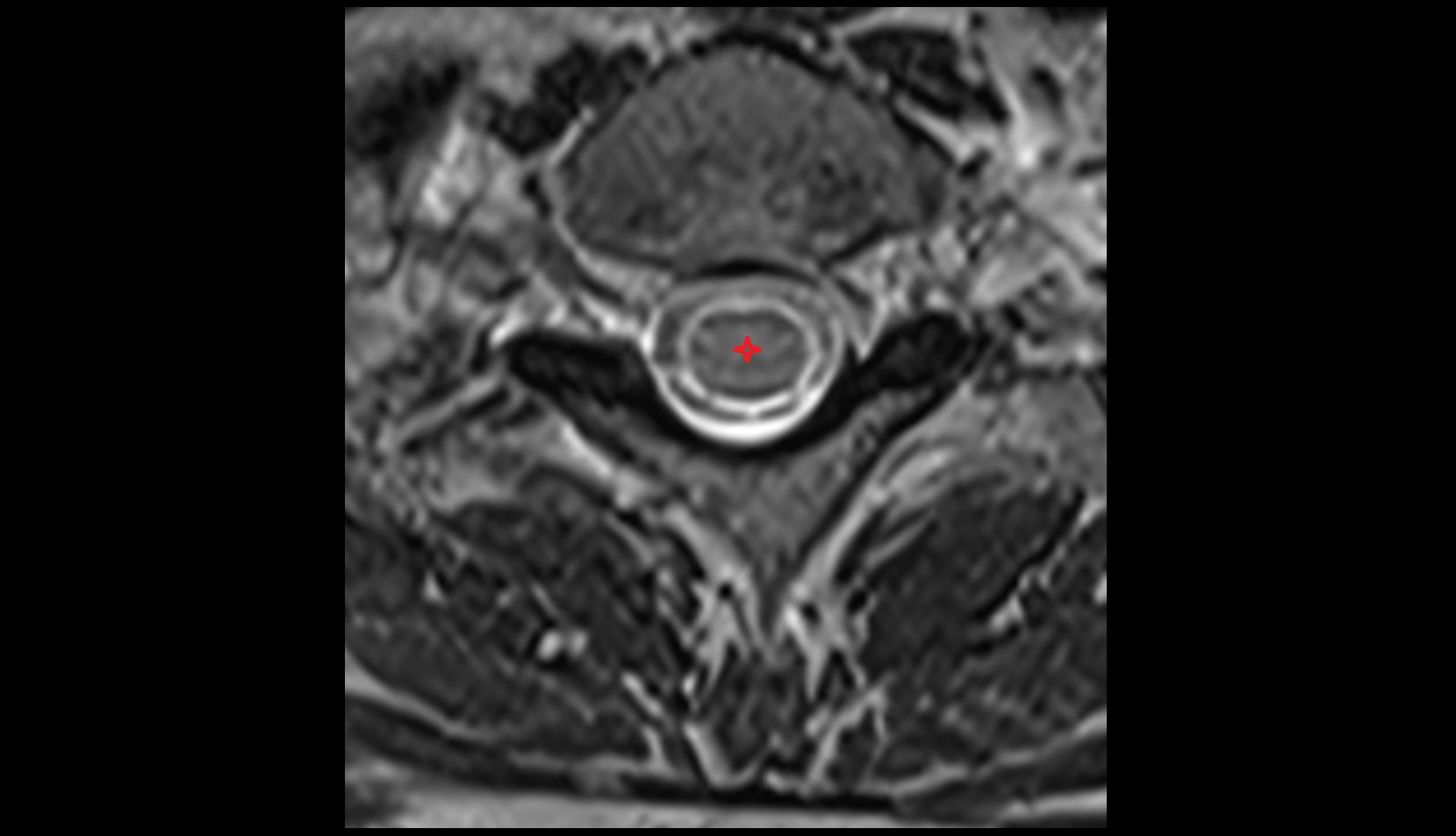 Spinal cord mri axial