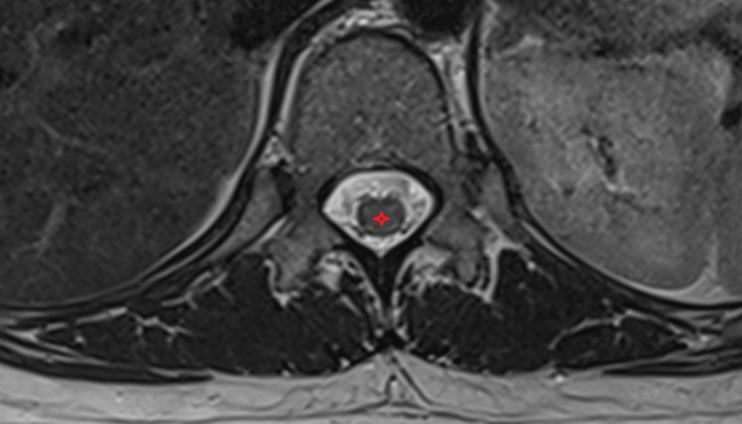 Spinal cord  mri  axial anatomy  image-img-00000-00000