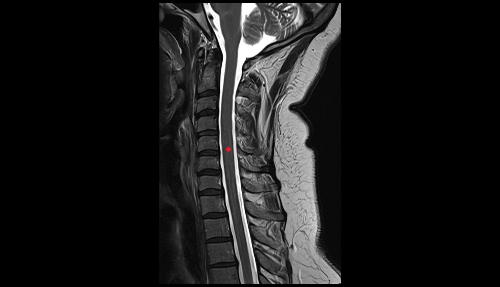 Spinal cord mri sag image