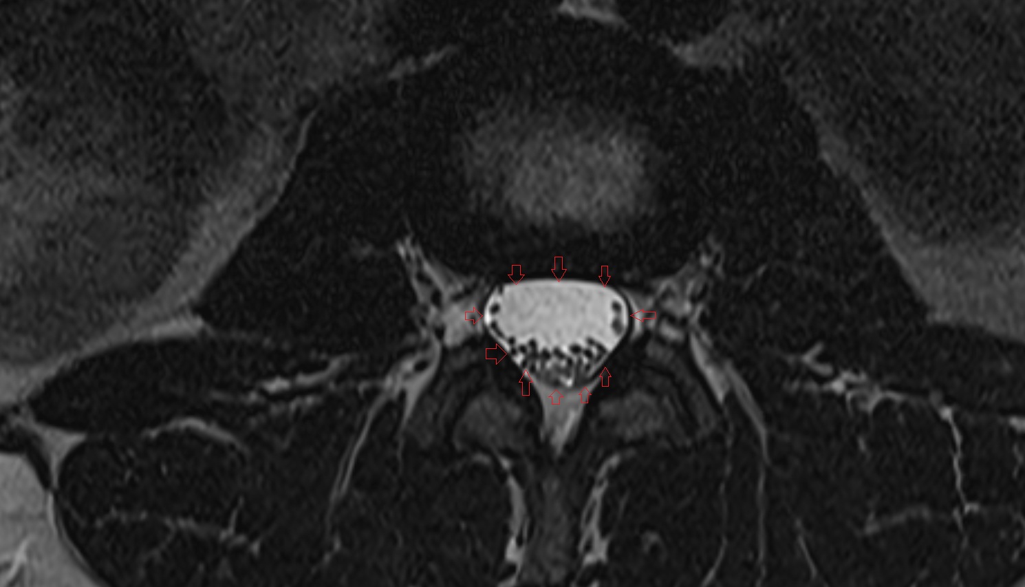Spinal dura mater MRI axial  anatomy  image-img-00000-00000