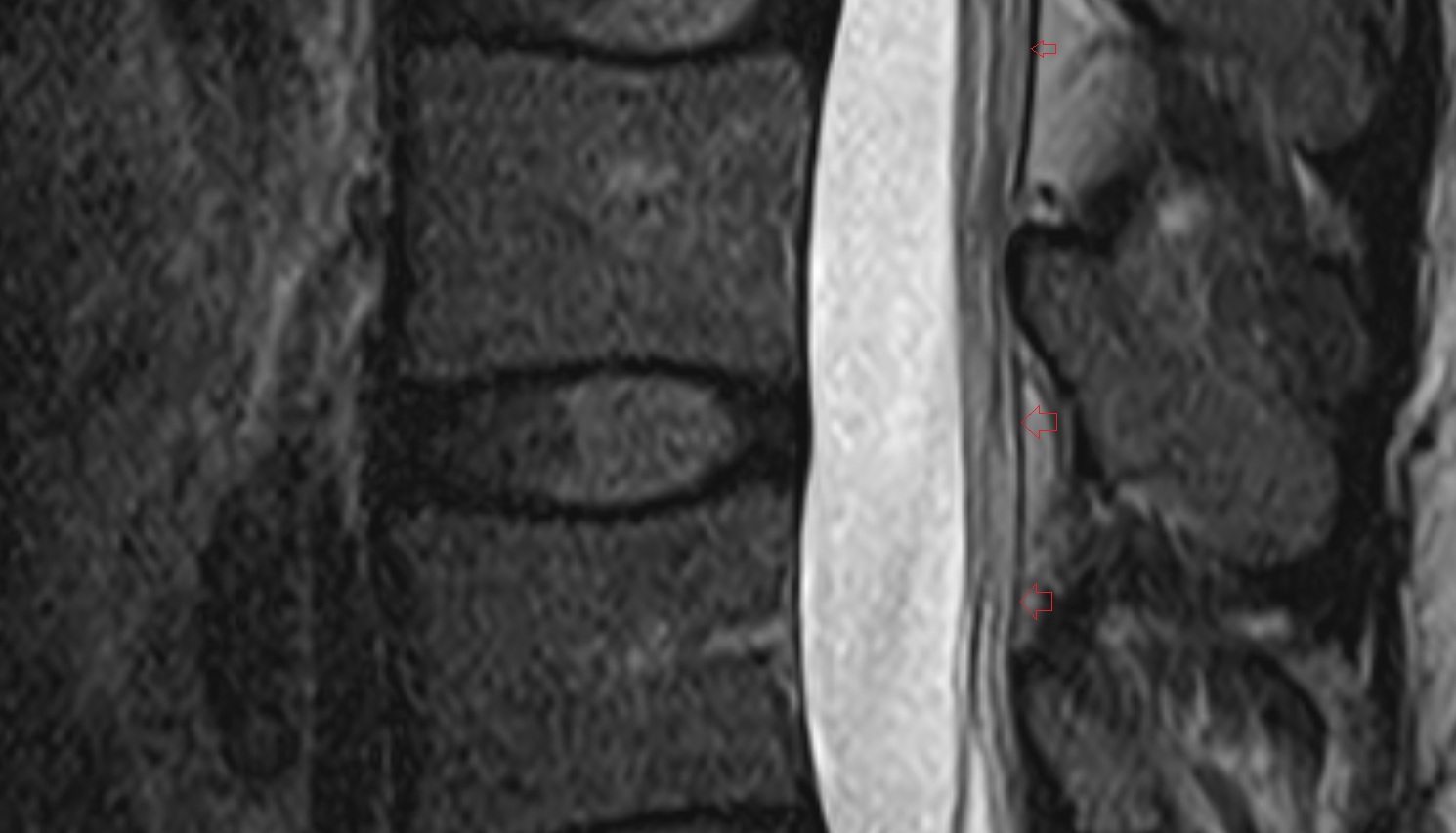 Spinal dura mater MRI sagittal  anatomy  image-img-00000-00000