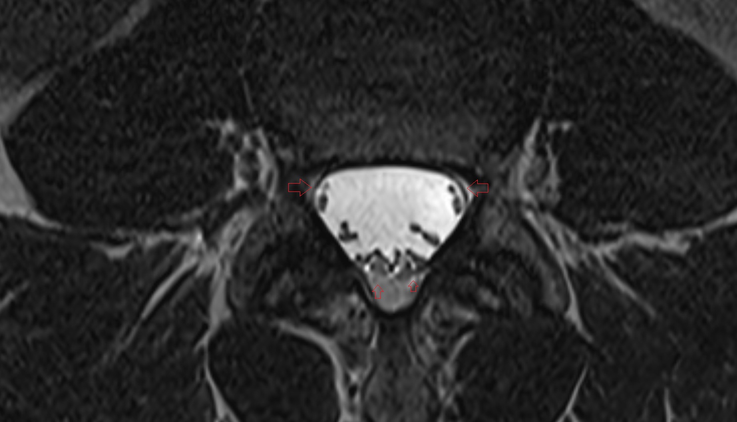 Spinal epidural space MRI axial  anatomy  image-img-00000-00000