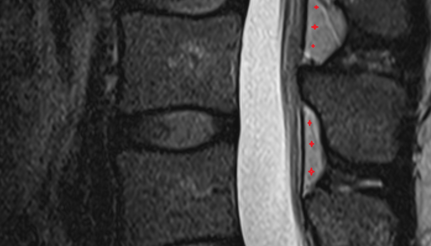 Spinal epidural space MRI sagittal  anatomy  image-img-00000-00000