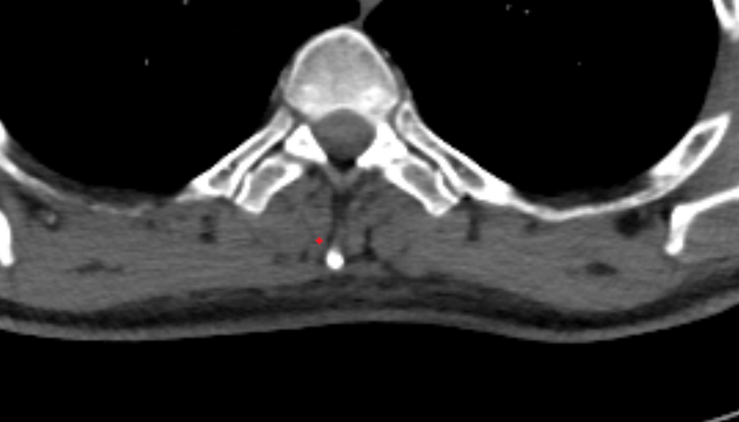 Spinalis muscle  anatomy  CT  axial  image -img-00000-00000