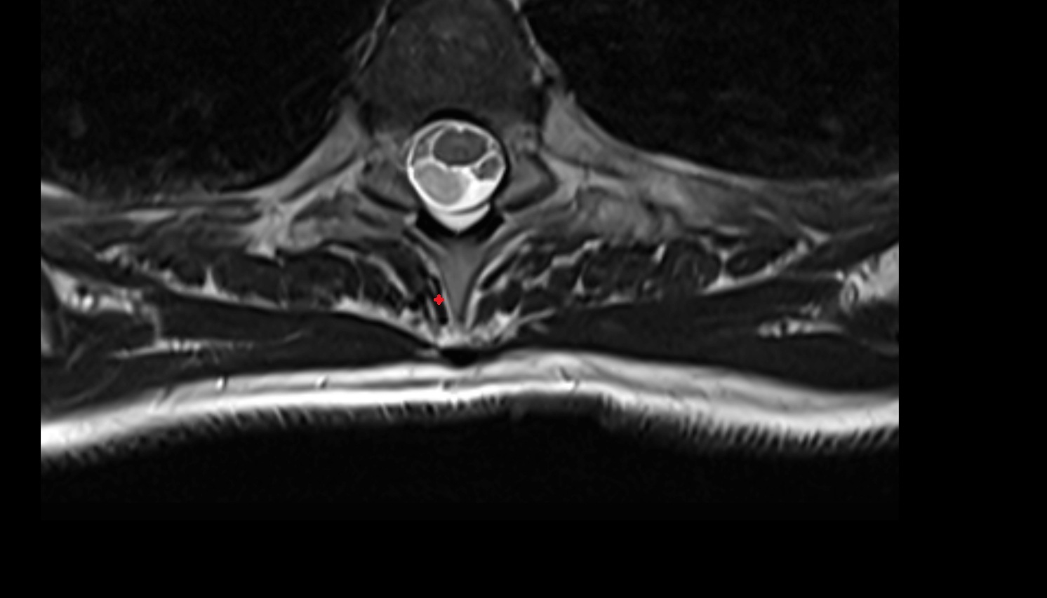 Spinalis muscle  anatomy MRI  axial  image -img-00000-00000