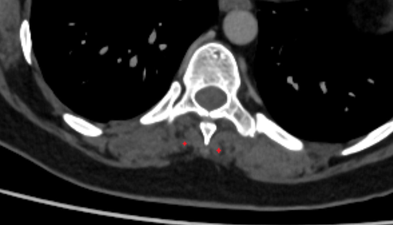 Spinalis thoracis muscle  ct axial  anatomy  image-img-00000-00000