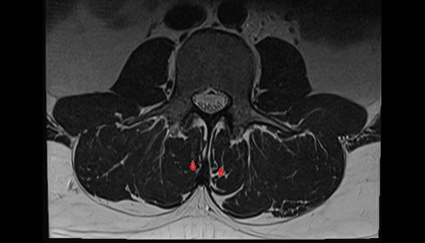 Spinalis thoracis muscle  mri  axial  anatomy  image-img-00000-00000