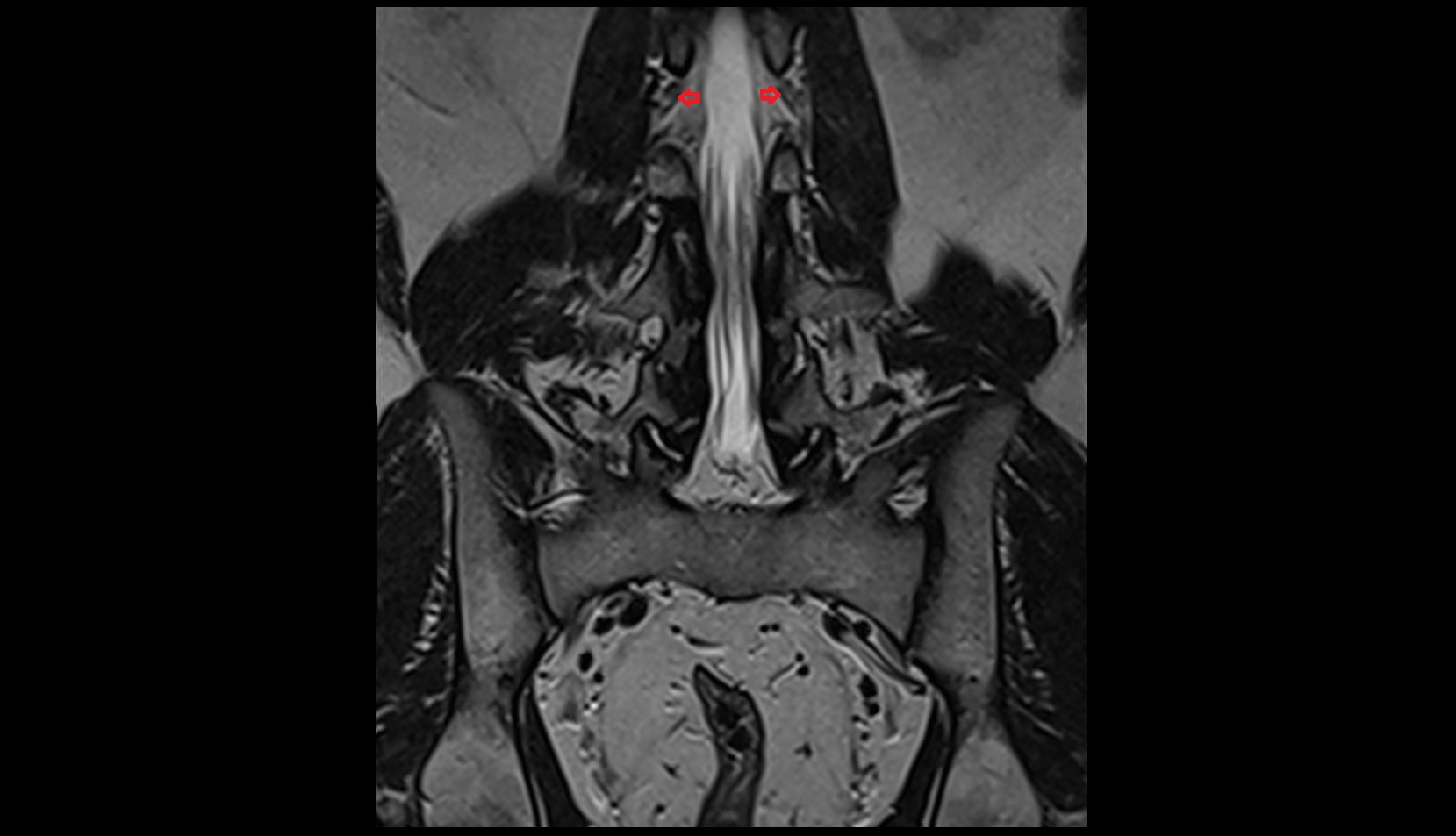 Spinal nerve L2 MRI sagittal anatomy  image