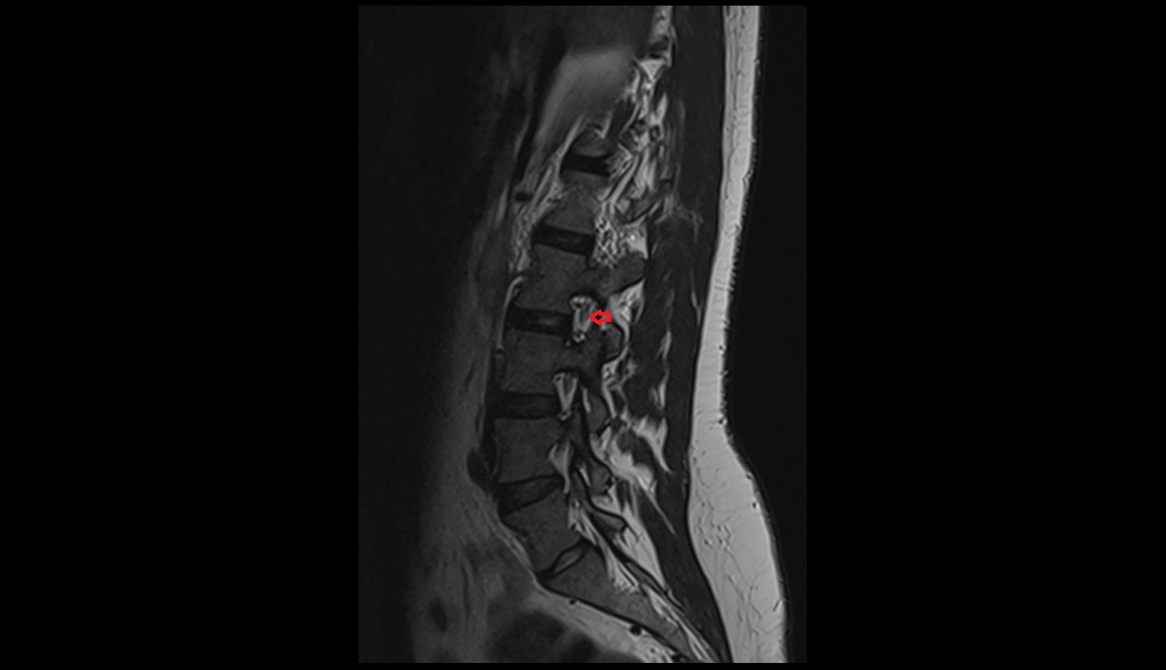 Spinal nerve L2 MRI coronal image