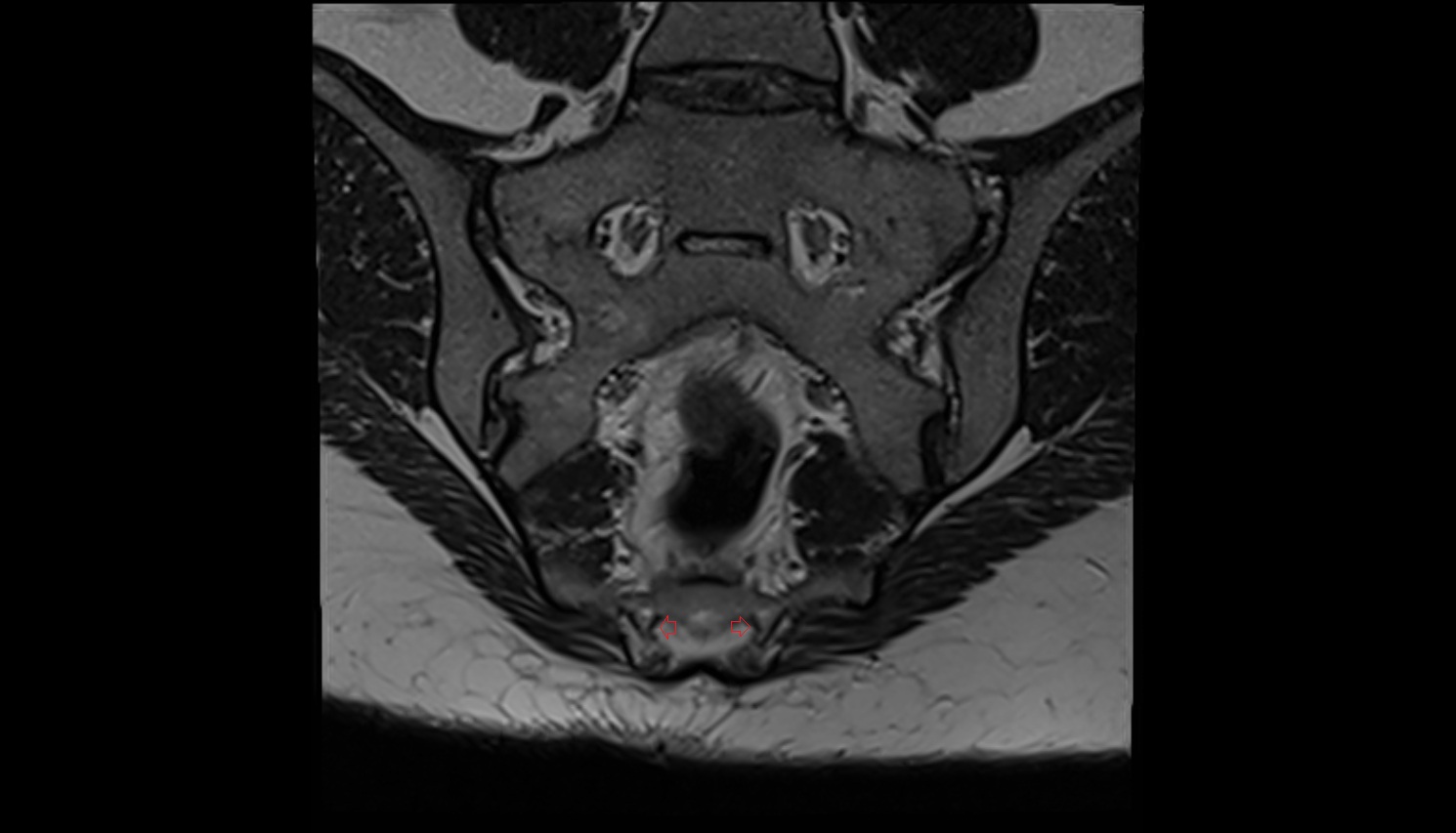 Spinal nerve S5  mri  CORONAL  anatomy  image-img-00000-00000
