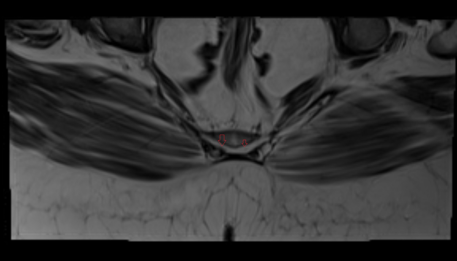 Spinal nerve S5  mri  axial  anatomy  image-img-00000-00000_00001