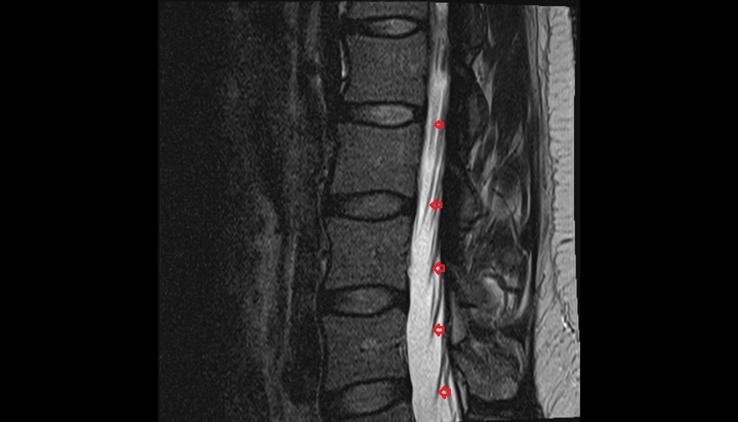 Spinal nerves  MRI sag anatomy  image -img-00000-00000