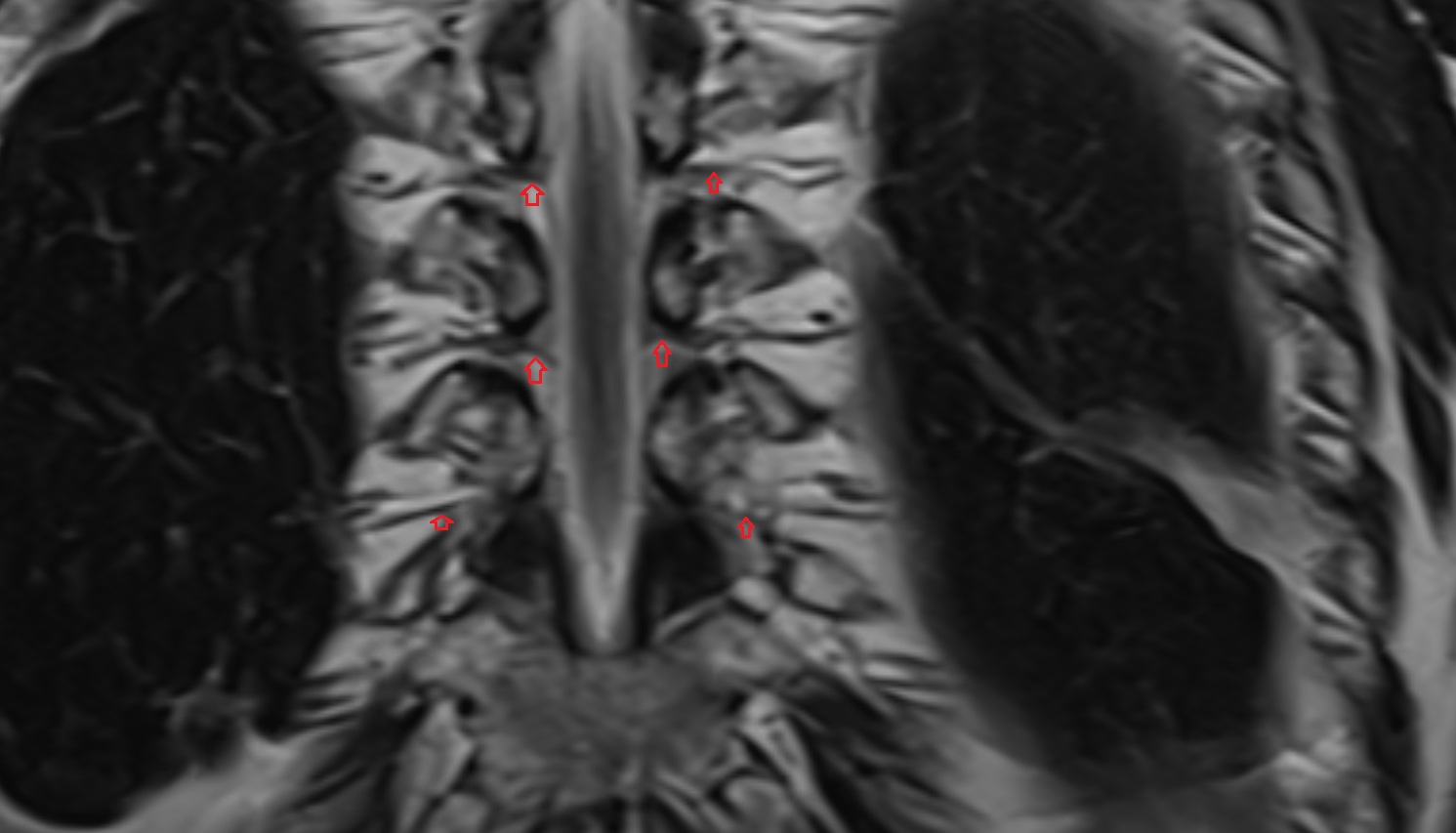 Spinal nerves  anatomy MRI coronal  image -img-00000-00000