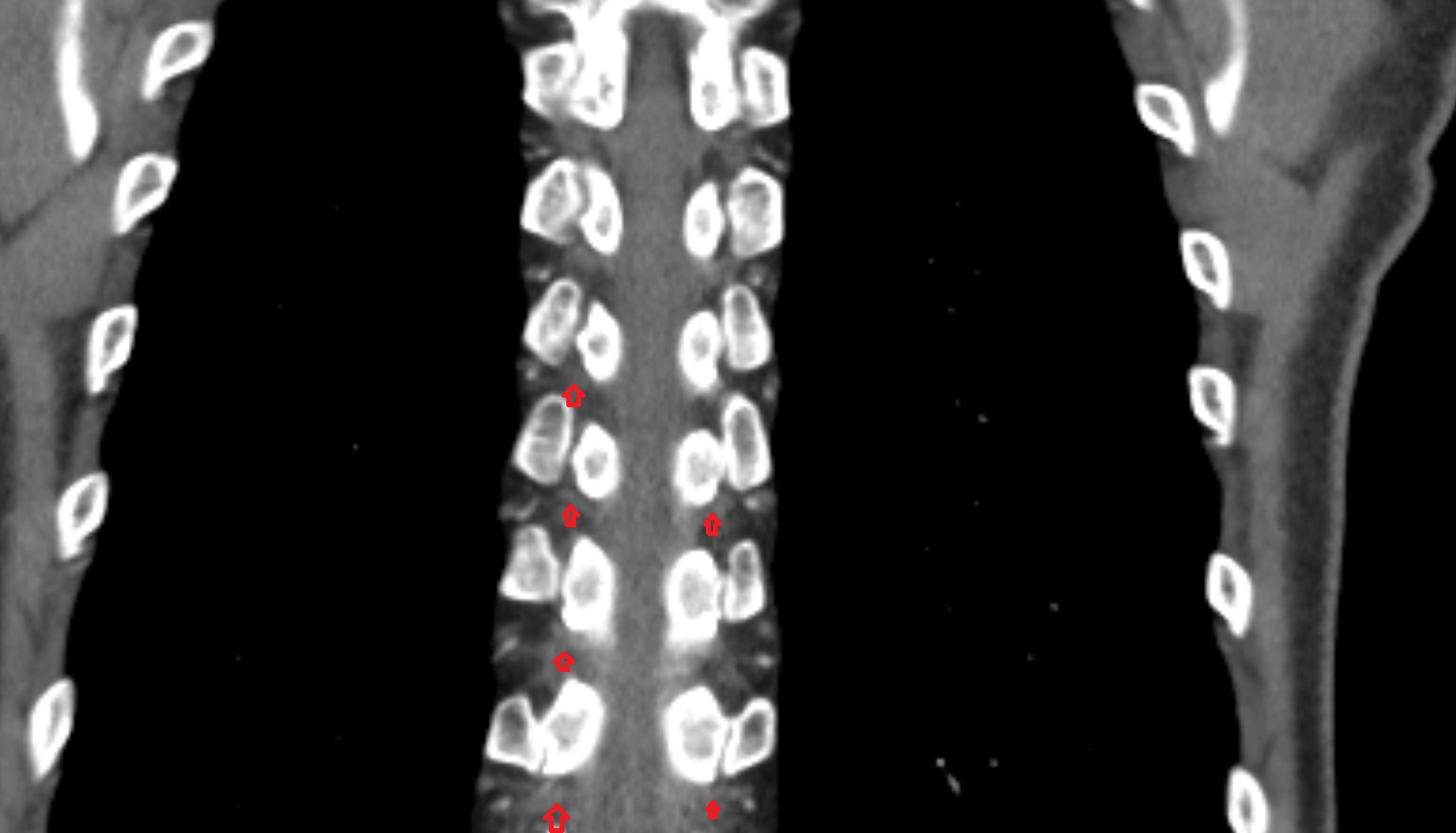 Spinal nerves  anatomy ct  coronal  image -img-00000-00000