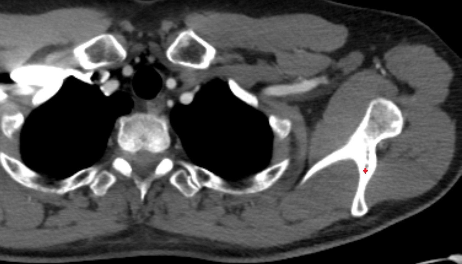 Spine of scapula CT axial  image -img-00000-00000
