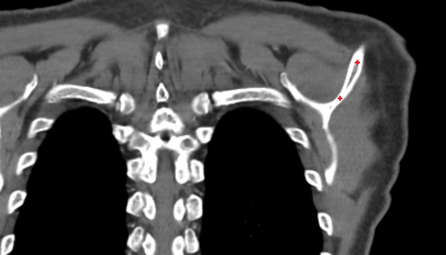 Spine of scapula CT coronal image -img-00000-00000