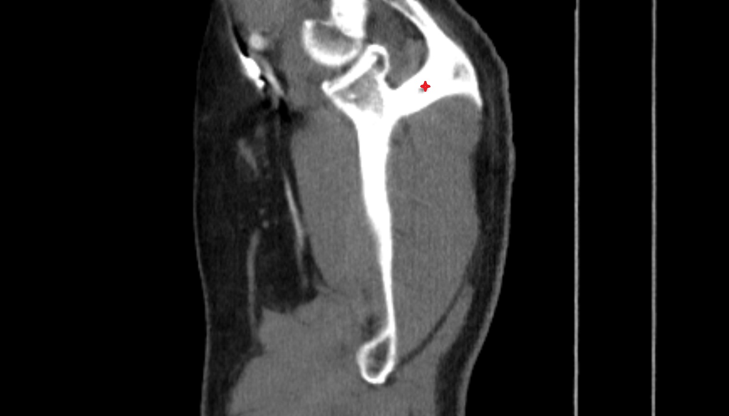 Spine of scapula CT sag  image -img-00000-00000