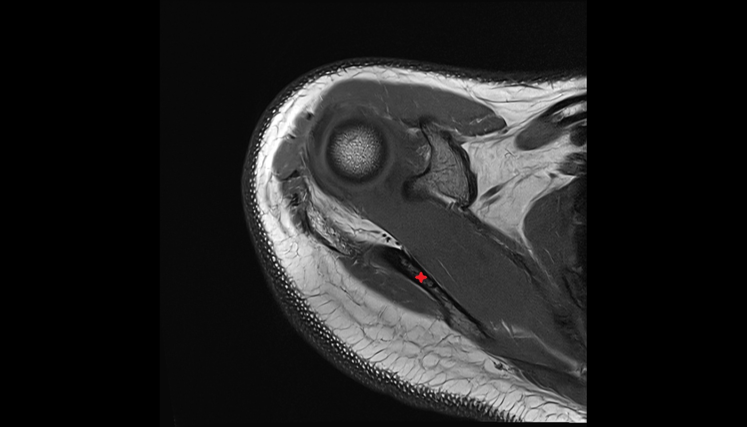 Spine of scapula MRI axial  image -img-00000-00000