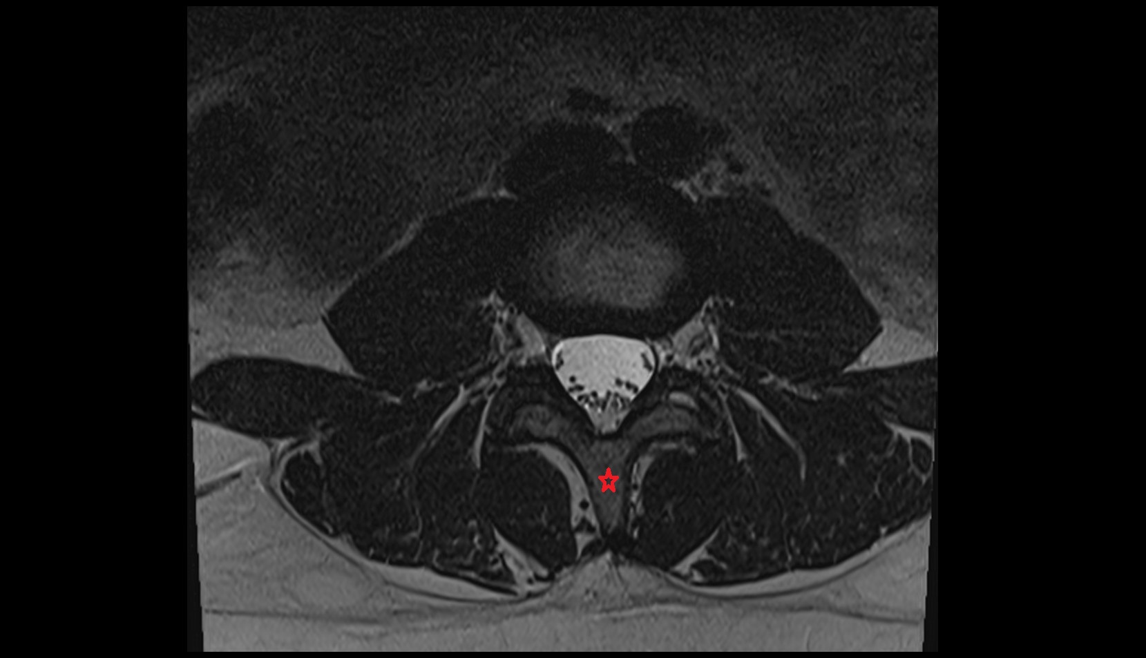 Spinous process of vertebra mri axial image