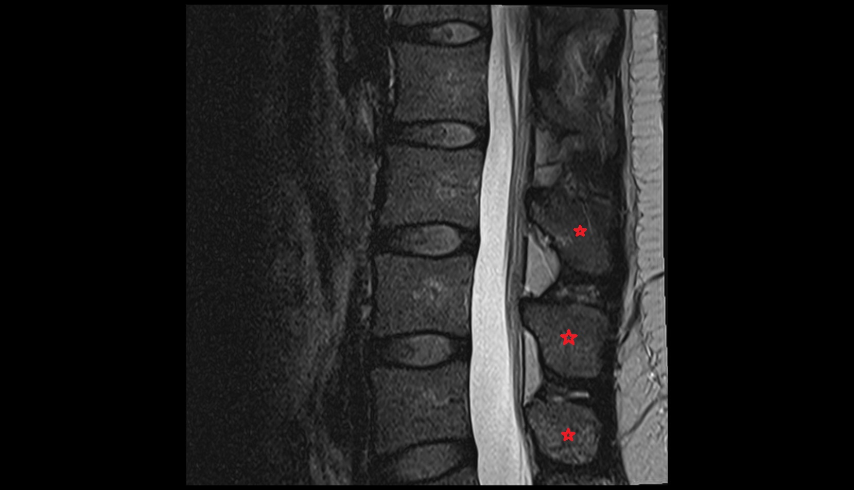 Spinous process of vertebra mri  sag  image