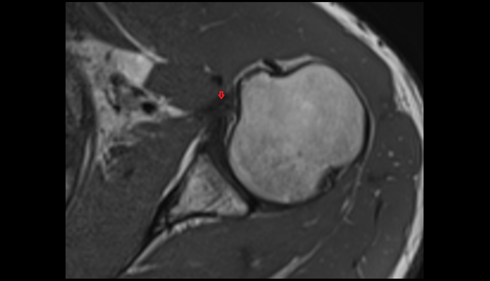 Spiral Glenohumeral Ligament mri axial mri image 2