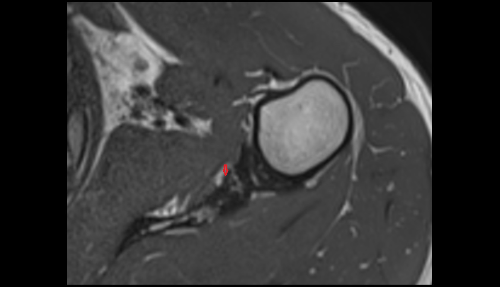 Spiral Glenohumeral Ligament mri axial mri image 3