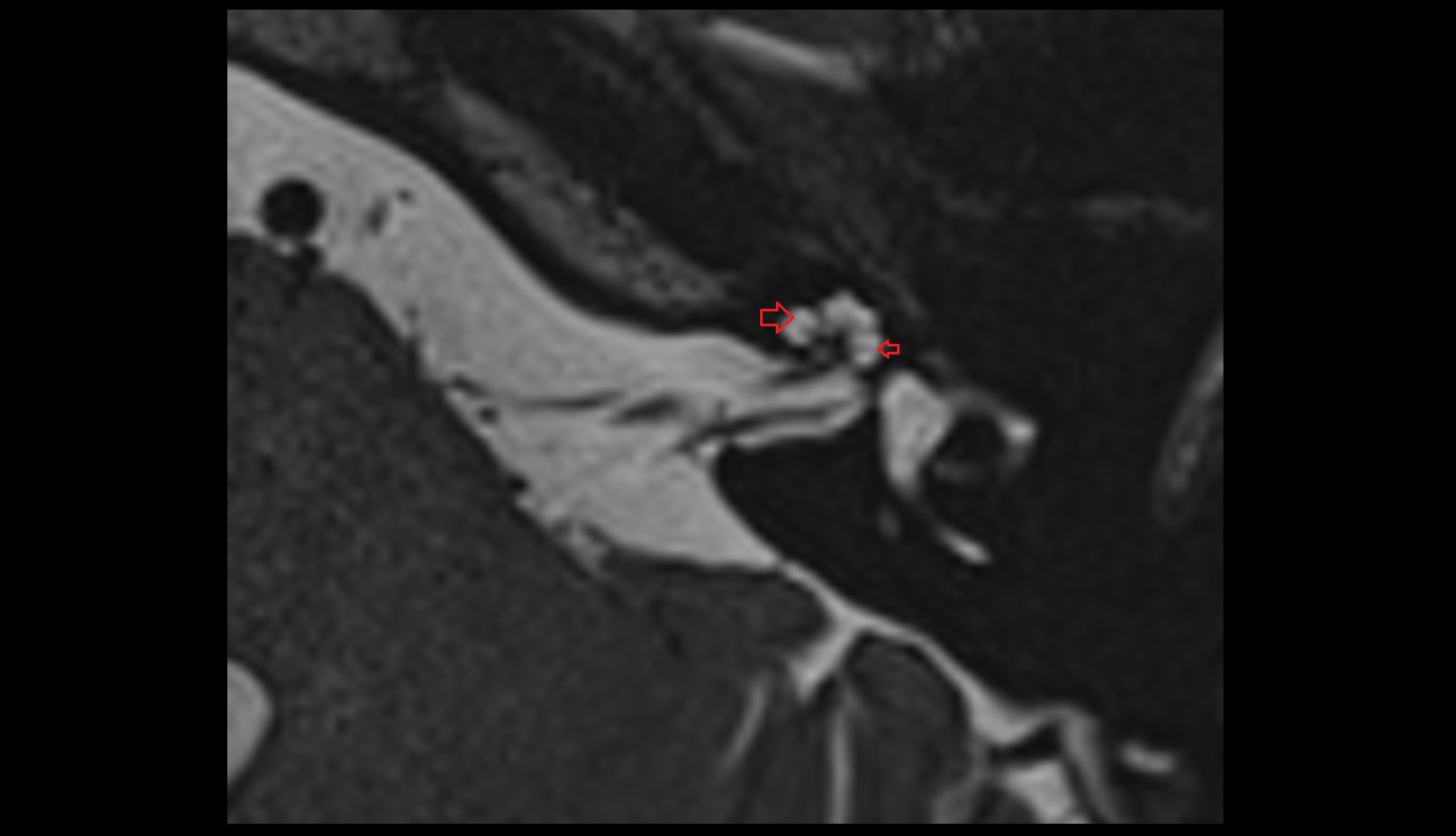 Spiral canal of cochlea mri axial image