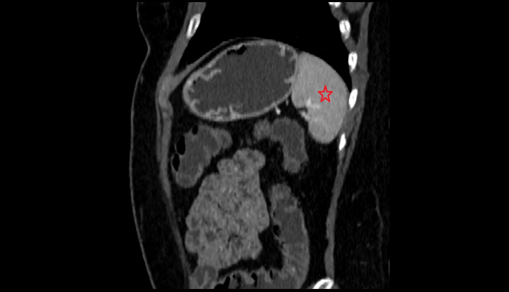 Spleen CT SAG IMAGE