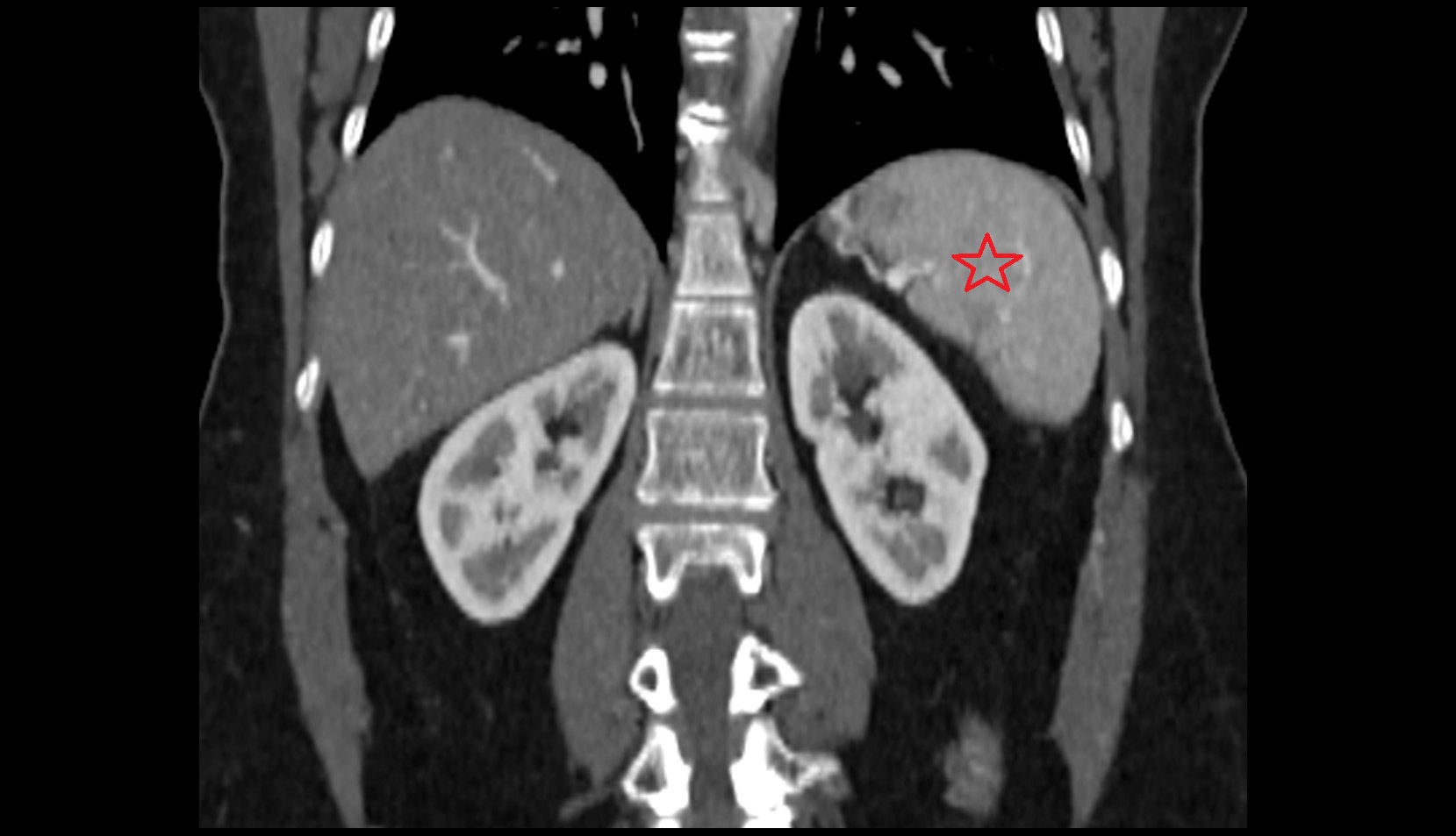 Spleen CT coronal image
