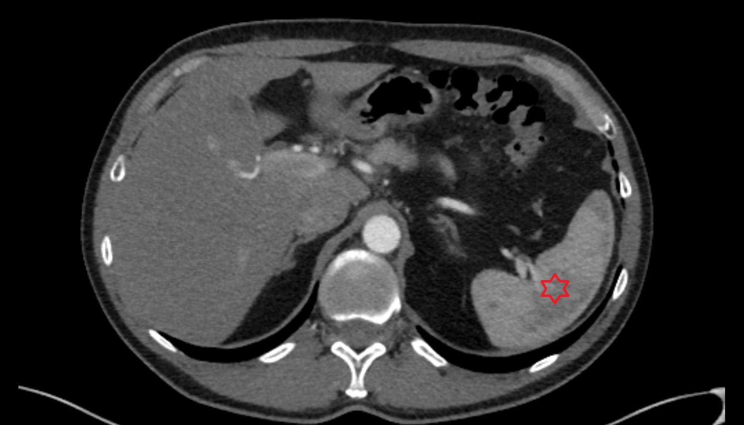 Spleen  anatomy CT axial  image -img-00000-00000