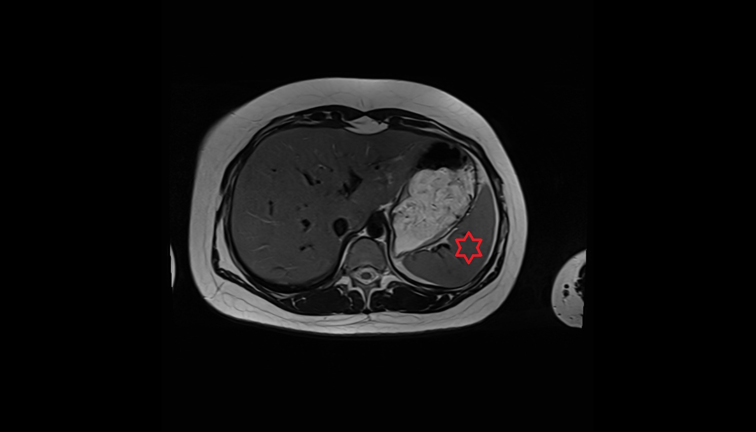 Spleen  anatomy MRI axial  image -img-00000-00000