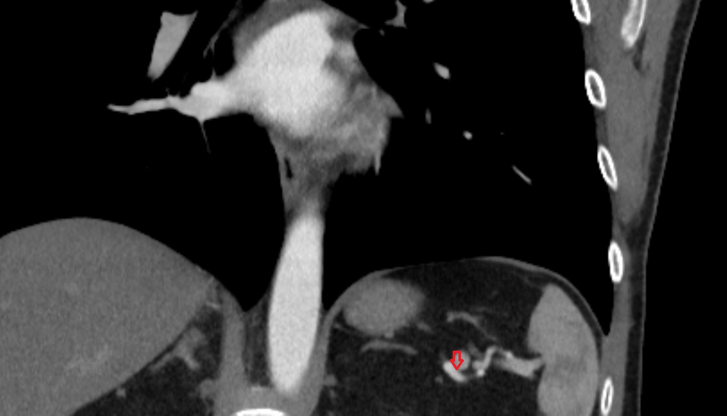 Splenic artery anantomy  CTCORONAL  image -img-00000-00000