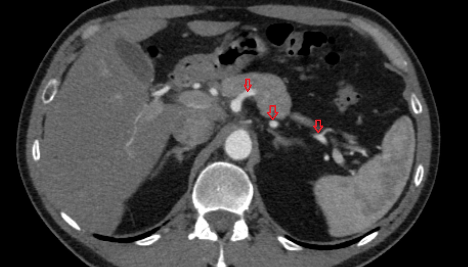 Splenic artery anantomy  CT axial  image -img-00000-00000