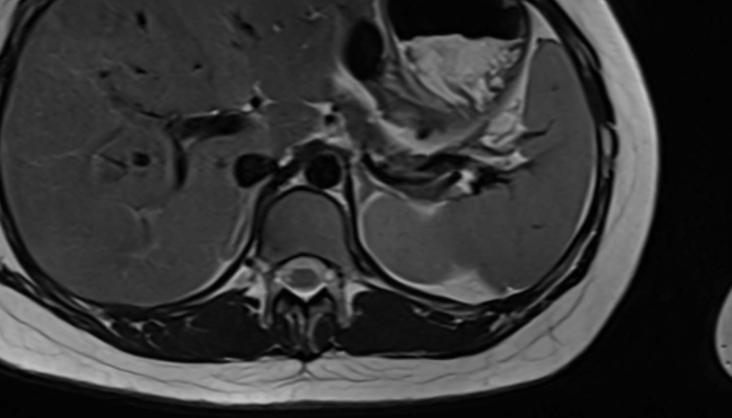 Splenic artery anantomy  MRI AXIAL  image -img-00000-00000