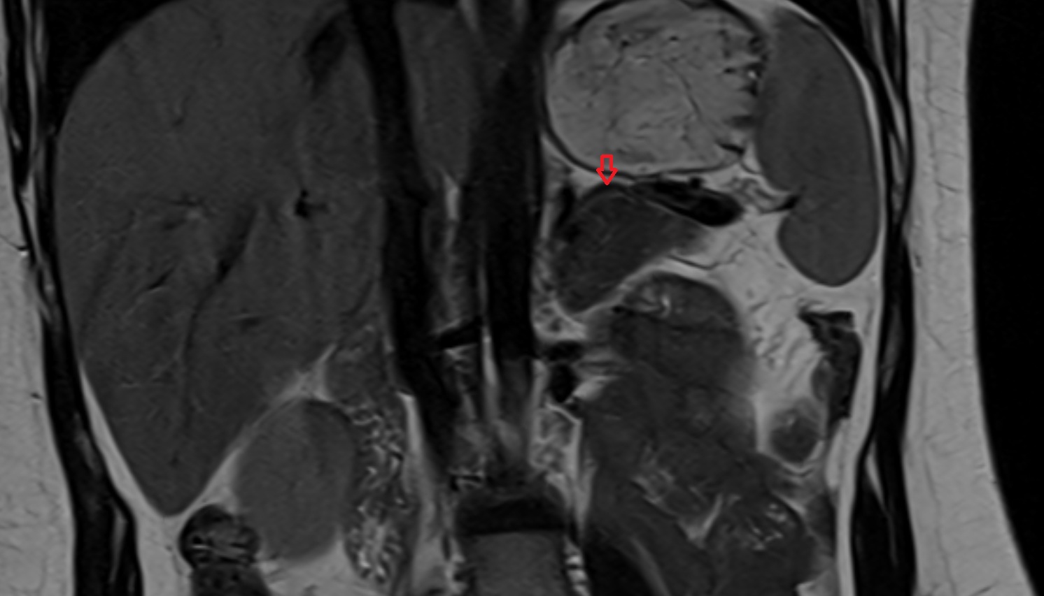 Splenic artery anantomy  MRI CORONAL  image -img-00000-00000