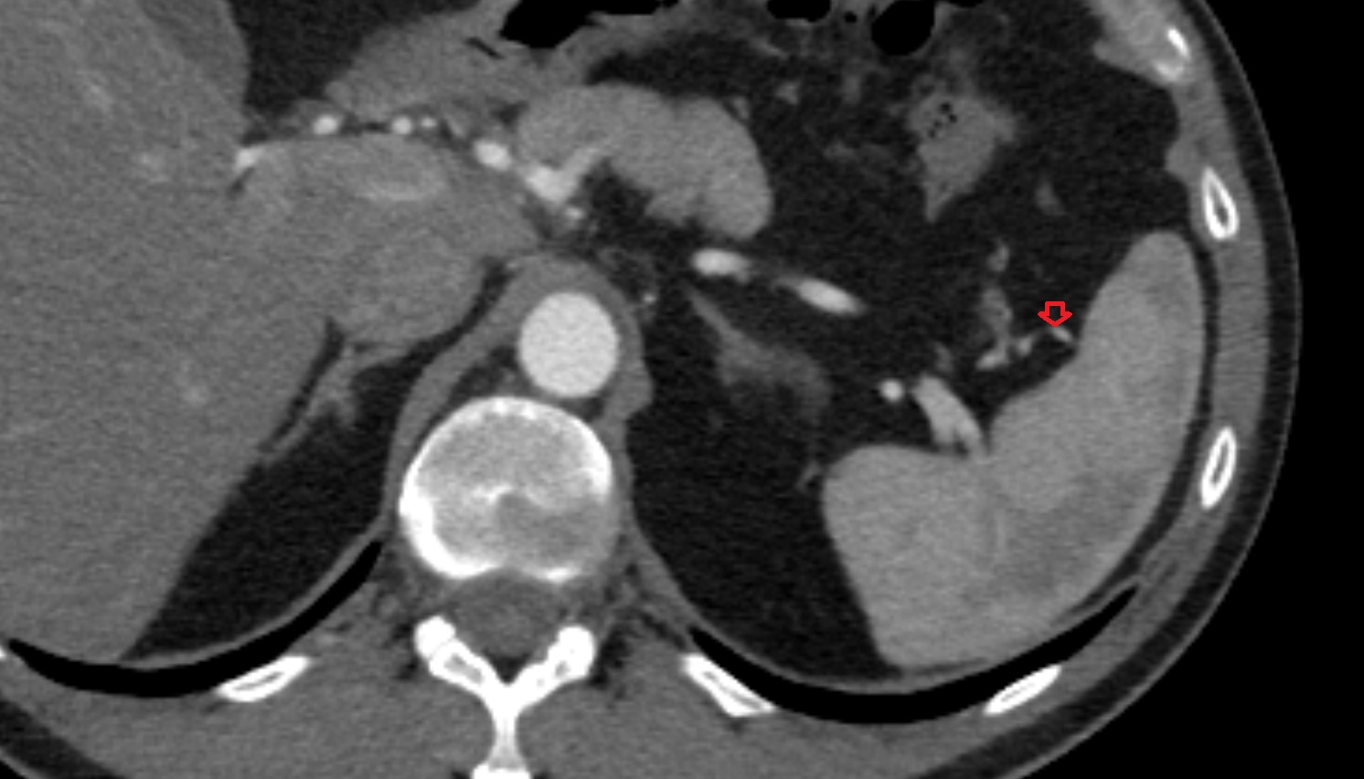 Splenic branches of splenic artery  anatomy CT axial  image -img-00000-00000