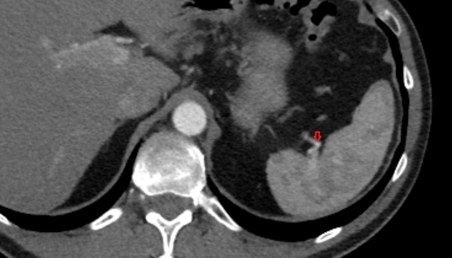 Splenic branches of splenic artery  anatomy CT axial  image -img-00000-00000_00001