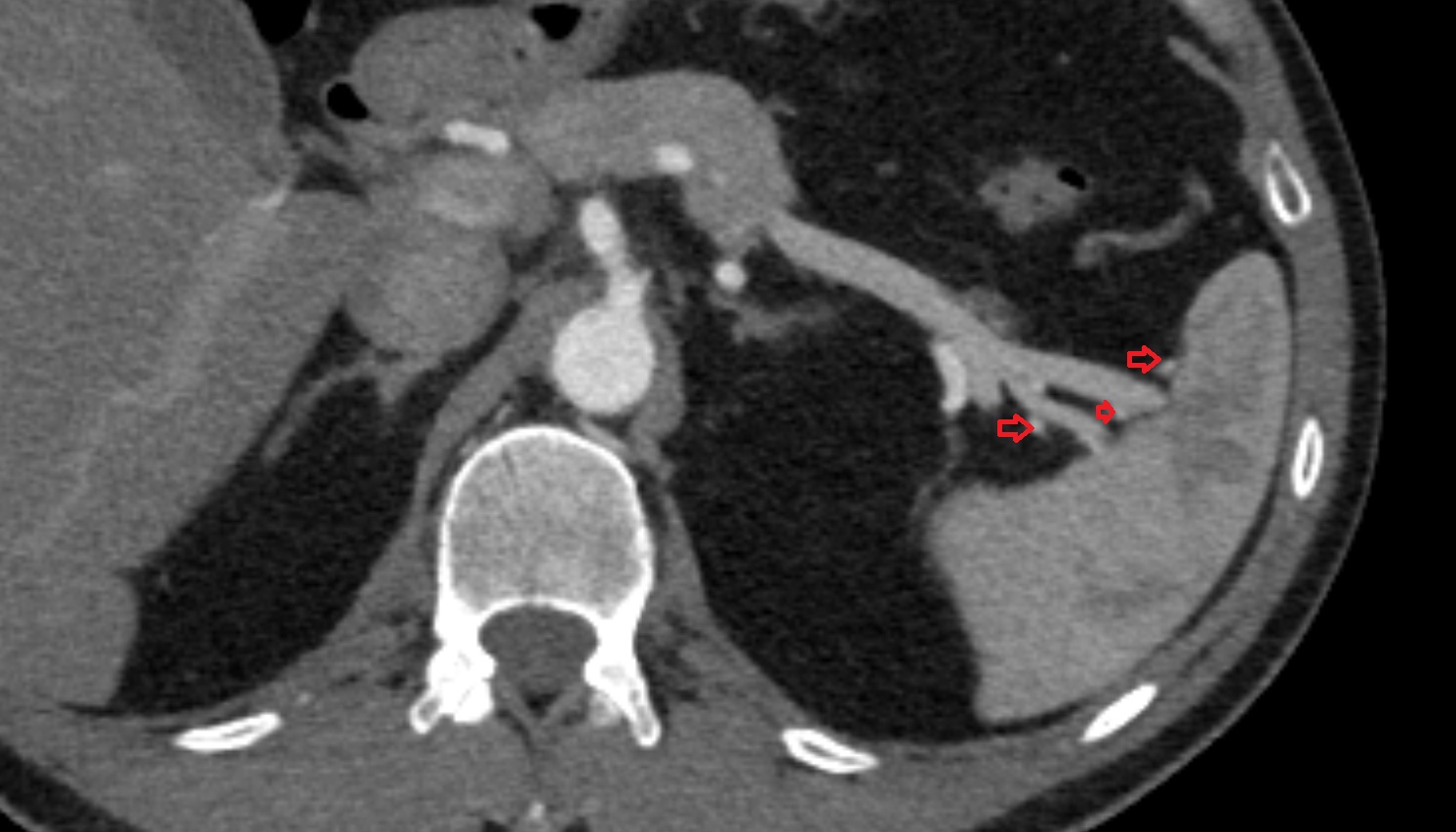 Splenic branches of splenic artery  anatomy CT axial  image -img-00000-00000_00002