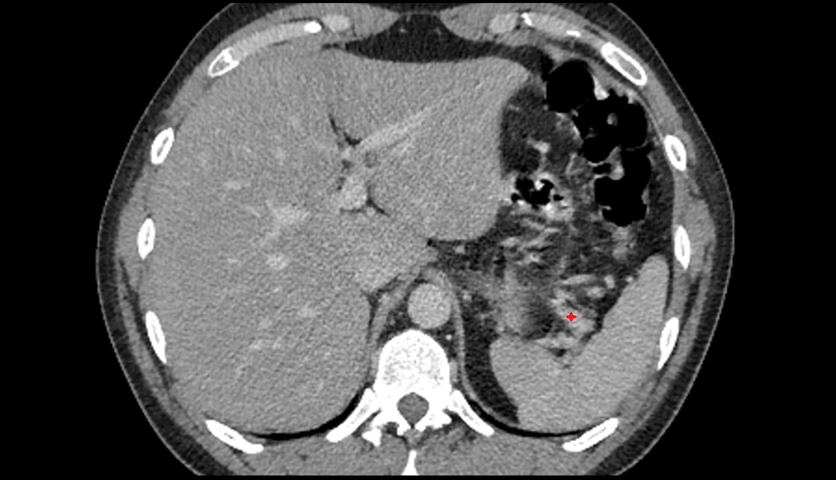 Splenic vein anatimy ct image