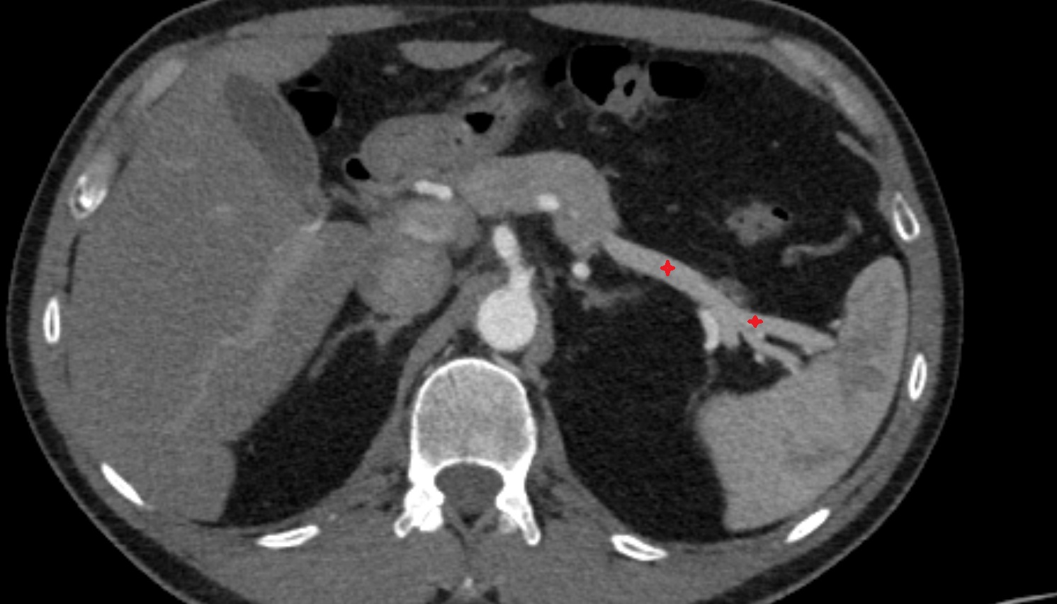 Splenic vein  anatomy CT  axial image -img-00000-00000