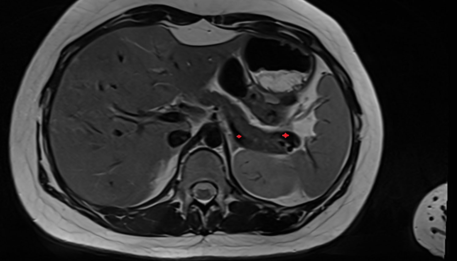 Splenic vein  anatomy MRI  axial image -img-00000-00000