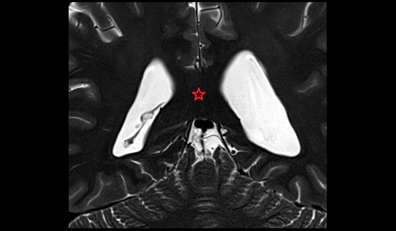 Splenium of corpus callosum mri 3t coronal image