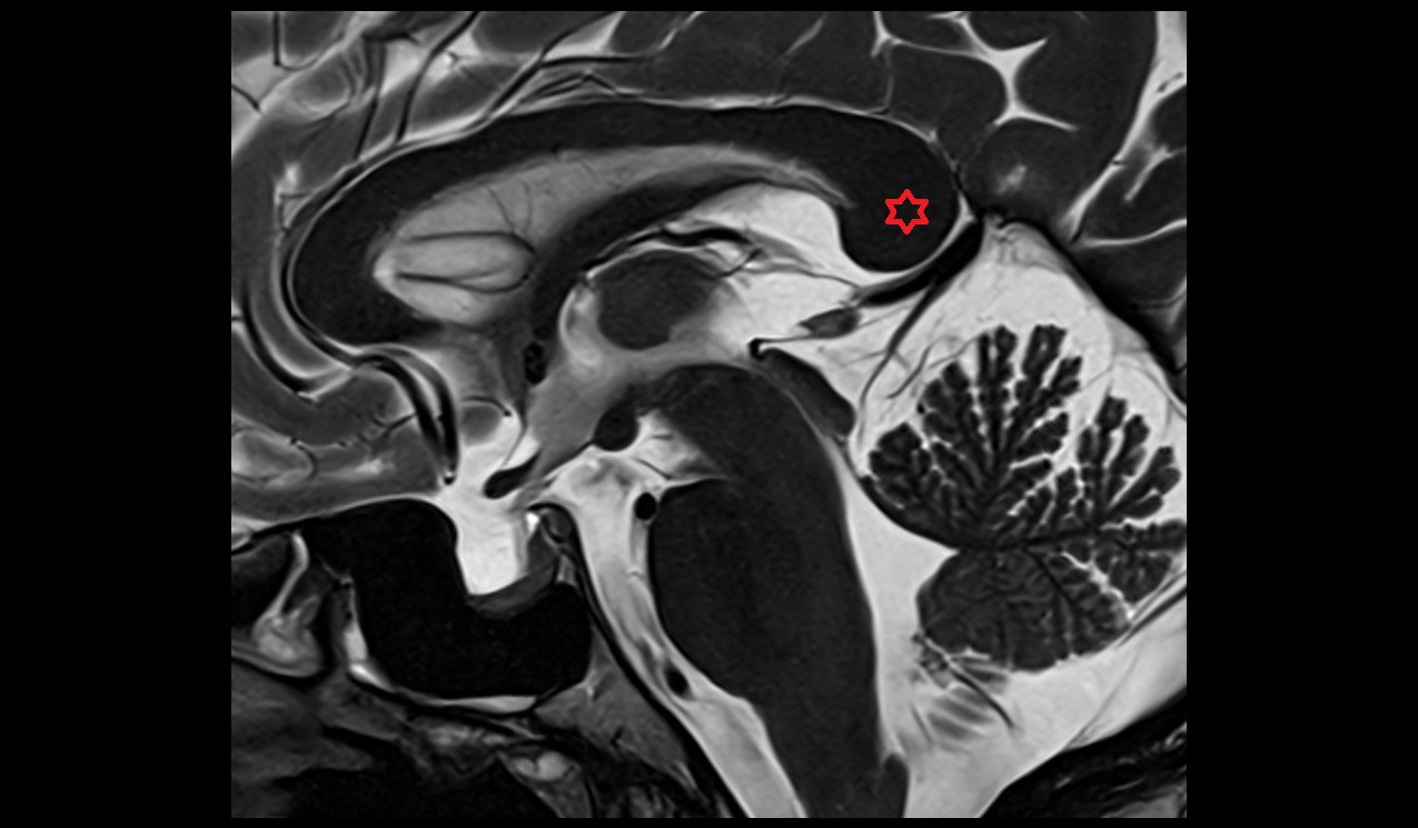 Splenium of corpus callosum mri 3t sagittal image