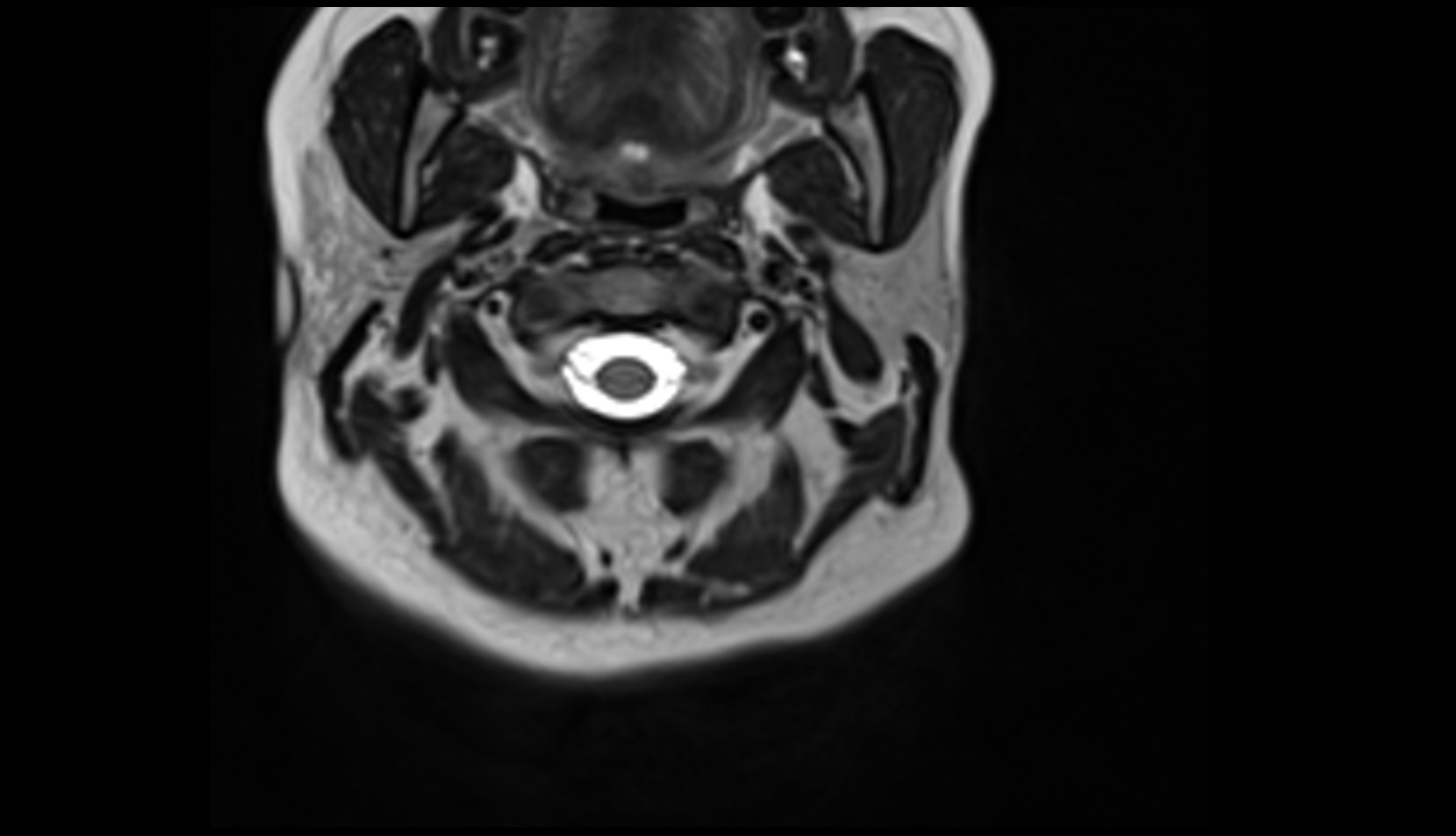 Splenius capitis muscle mri axial image