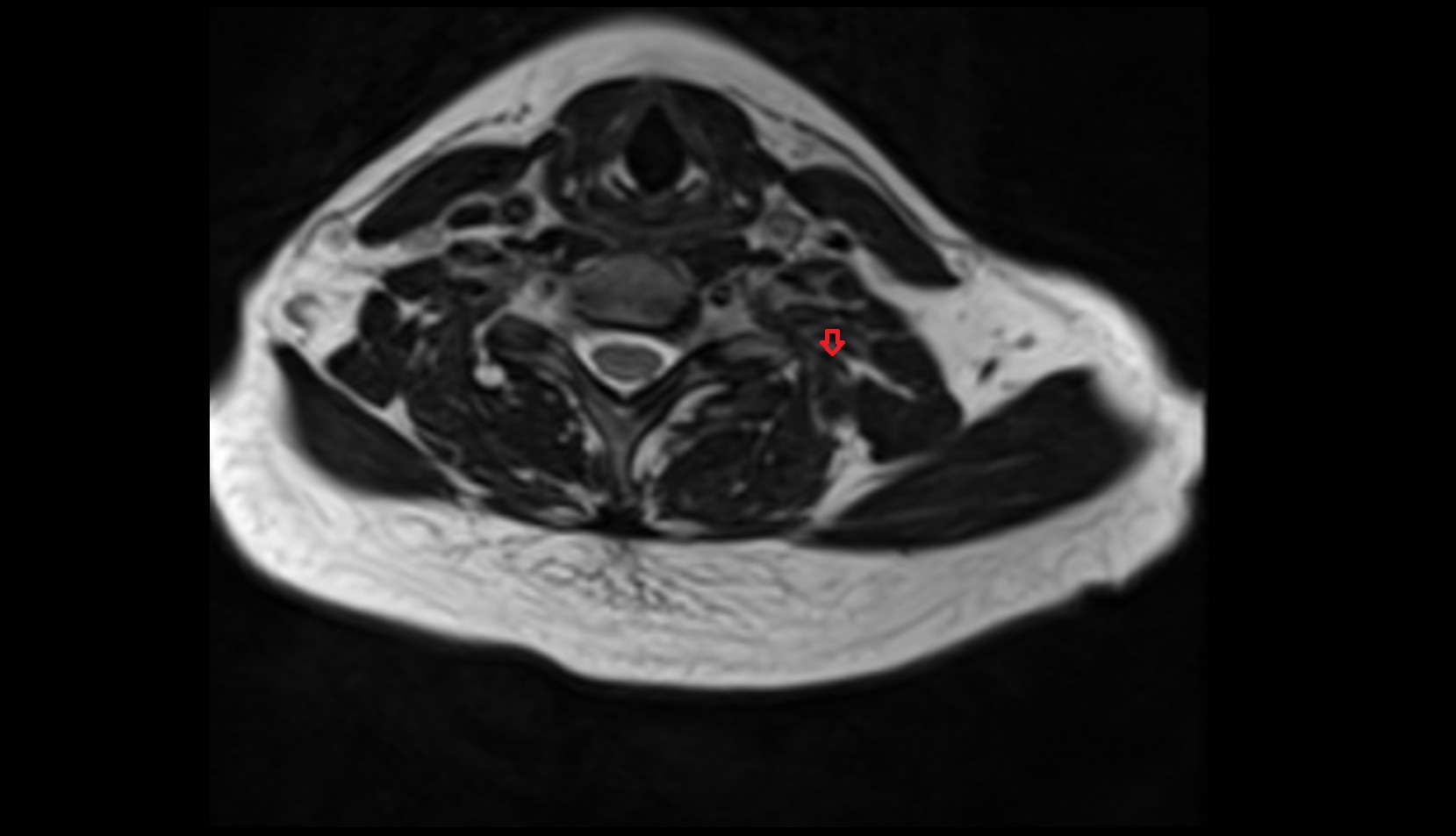 Splenius cervicis muscle mri axial image